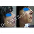Manufacturers Exporters and Wholesale Suppliers of Invasive Facial Rejuvenation New Delhi Delhi